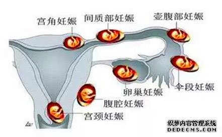 宫外孕妊娠分布图