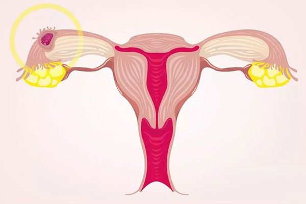 子宫内膜增厚治疗后会复发吗